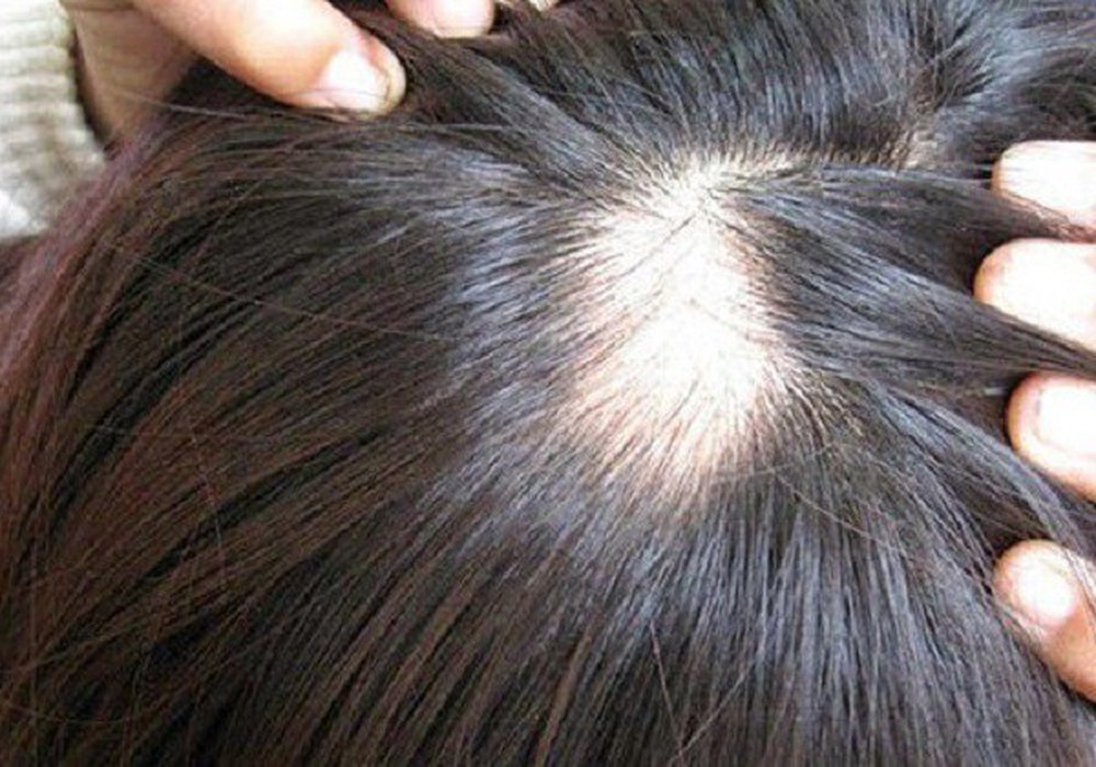 Rụng tóc Andogen điều trị như thế nào?