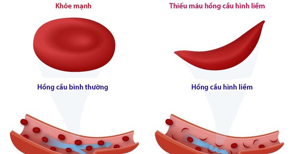 Thiếu máu hồng cầu hình lưỡi liềm là gì, điều trị thế nào?