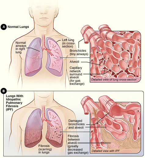 Bệnh xơ phổi vô căn (IPF) là gì? Điều trị như thế nào?