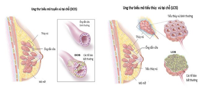 Những điều cần biết về ung thư biểu mô tuyến vú
